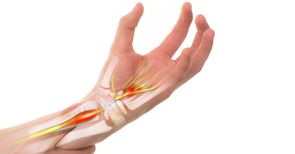 Opções de Tratamento para Aliviar a Síndrome do Túnel do Carpo